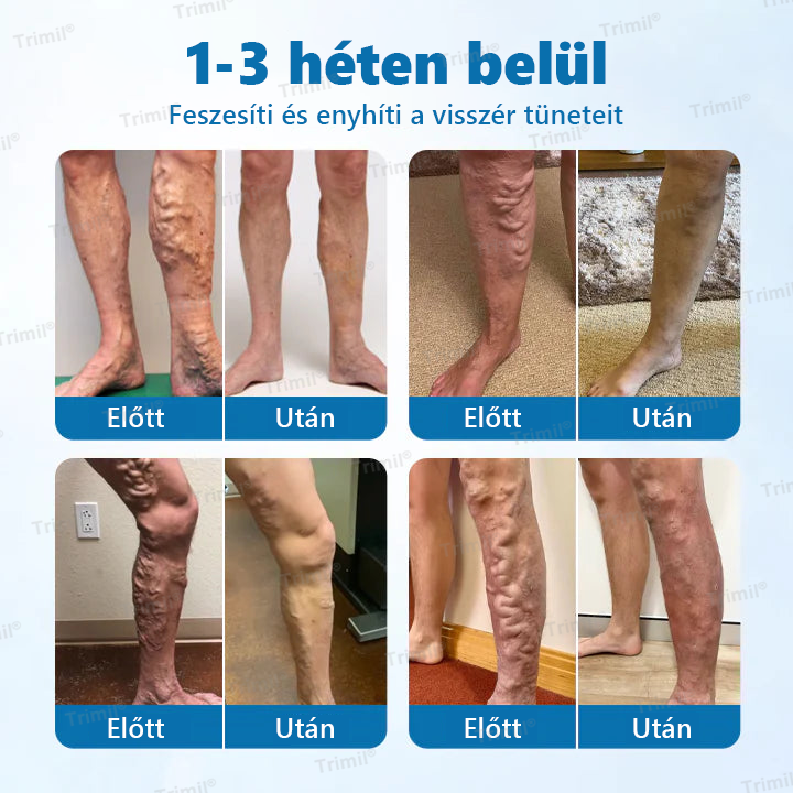 💚Trimil® VeinGuard Gyógynövényes Spray - ✅ Klinikailag bizonyított, hogy mindössze 7 nap alatt megszünteti a visszereket!✅