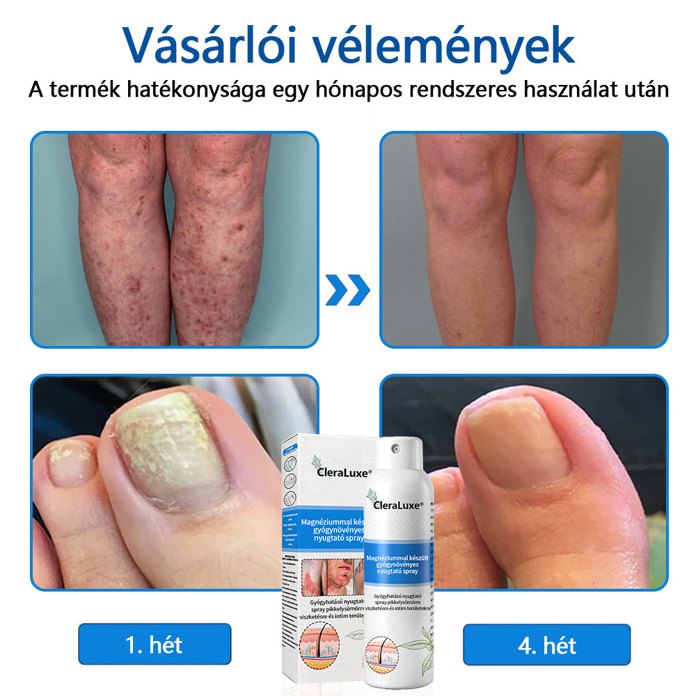 CleraLuxe®  Magnézium Gyógynövényes Pszoriázis Spray🌟🌟