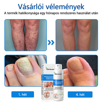 CleraLuxe®  Magnézium Gyógynövényes Pszoriázis Spray🌟🌟